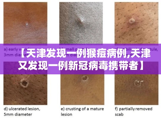 【天津发现一例猴痘病例,天津又发现一例新冠病毒携带者】
